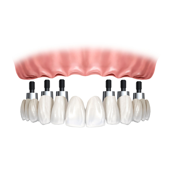 Implantes dentários